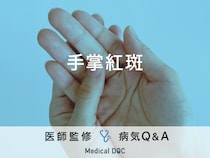 「手掌紅斑（しゅしょうこうはん）」ができる原因はご存知ですか？医師が監修！
