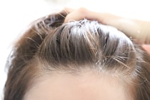 「女性の薄毛は改善」できる？薬や原因についても詳しく解説！