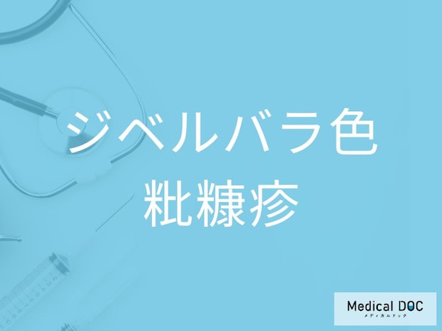 その発疹やかゆみ、「ジベルバラ色粃糠疹」が原因かも？ 初期症状と進行パターンを医師が解説
