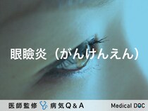 「眼瞼炎（がんけんえん）」になると現れる症状はご存知ですか？医師が監修！