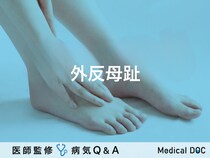 「外反母趾」とは？治療法・原因・予防法についても解説！医師が監修！