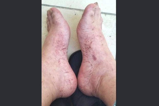 皮膚筋炎、間質性肺炎の症状の始まり