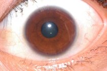 網膜色素変性症の症状や原因、治療方法とは？