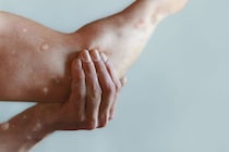 「サル痘」国内2人目の感染確認　日本の検査・治療体制はどうなっている？