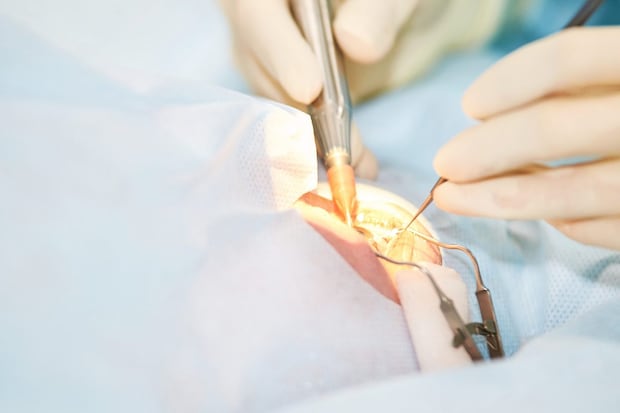 【閉塞隅角緑内障の治療】手術・レーザー治療編