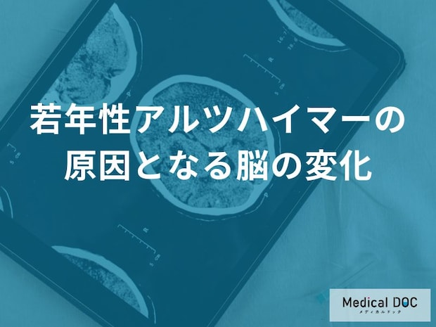 40代から脳が縮み始める?「若年性アルツハイマー」の原因の正体とは