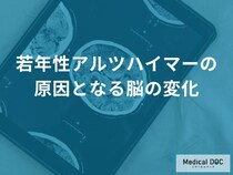 40代から脳が縮み始める？「若年性アルツハイマー」の原因の正体とは