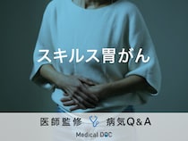 「スキルス胃がん」になると現れる症状・原因・胃がんとの違いはご存知ですか？