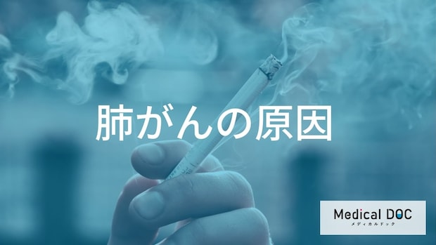 『肺がん』の原因はタバコ？ 遺伝との関係や発症の仕組みを解説【医師監修】