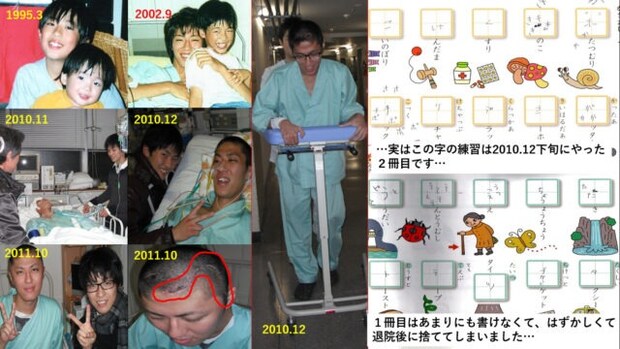 【闘病】若気の至りの『喫煙』で「脳出血」 8年後の再発で『高次脳機能障害』に…