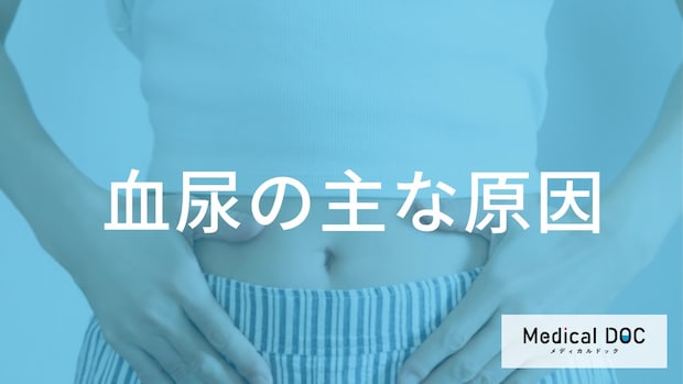 無症状の「血尿」は“膀胱がん”のサイン？ 原因となる病気や症状を解説！【医師監修】