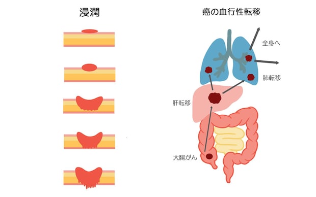 早期発見が重要である理由