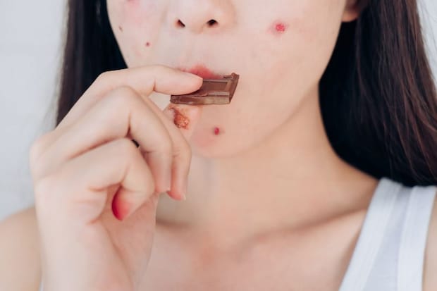 「チョコレートはニキビの原因」は噓だった!? 科学的な根拠はない? 医師がウワサの真相を暴露
