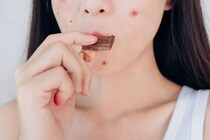 【医師解説】『チョコレートはニキビの原因』実は科学的に証明されていなかった