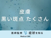 「皮膚に黒い斑点がたくさん」できる原因はご存知ですか？医師が徹底解説！