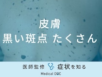 「皮膚に黒い斑点がたくさん」できる原因はご存知ですか？医師が徹底解説！
