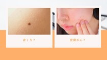 「ほくろ」と「皮膚がん」を見分ける方法はありますか？