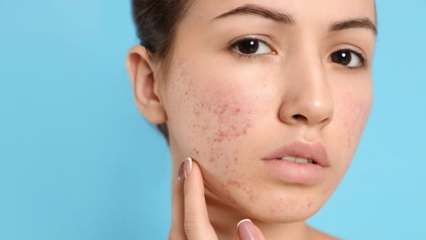 「ニキビの重症化」を防ぐには？ 早めに治療へ行くべき理由を医師が解説