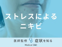 「ストレスでニキビ」ができる原因はご存知ですか？医師が徹底解説！