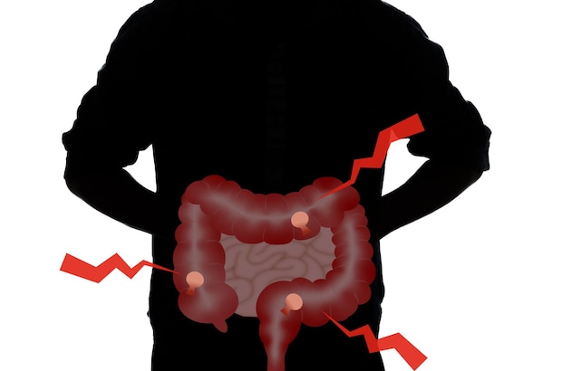 『大腸ポリープ』ができやすい人の特徴 医師が「特に大腸カメラをおすすめしたい人」とは?