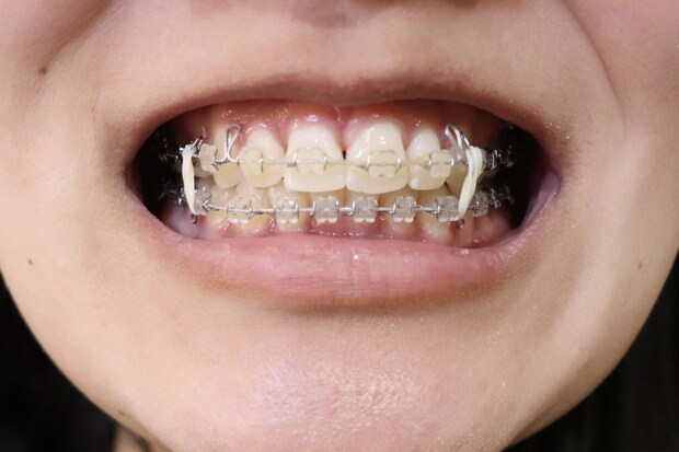 知っておくと安心！ ワイヤー矯正治療中の自己管理