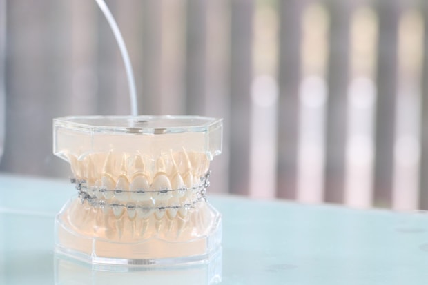 ワイヤー矯正を始めると日常はどう変わる？ 痛みや違和感、生活への影響