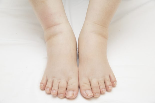 むくみからはじまった異変――。病気発覚と治療への第一歩