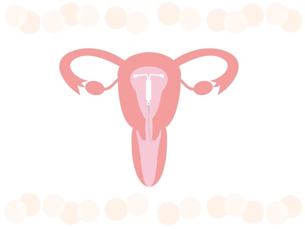 ミレーナとは？ どうやって使うの？