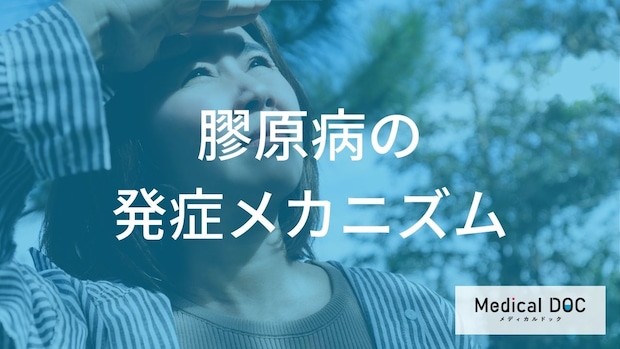 膠原病の前兆症状を医師が解説！ 日光過敏やウイルス感染後に注意したい免疫異常のサインとは