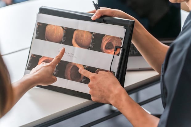 大腸カメラで見つかる病気とは？