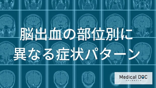 「脳出血」部位によって180度変わる「初期症状」の見分け方【医師解説】
