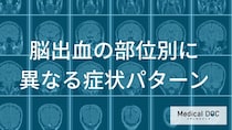 「脳出血」部位によって180度変わる「初期症状」の見分け方【医師解説】