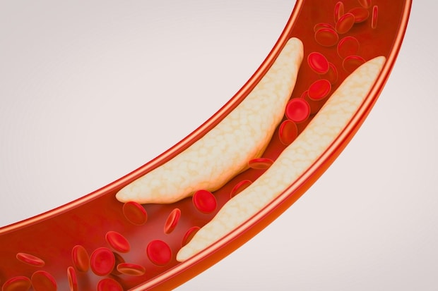 高血圧と動脈硬化の関係とは