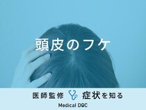 「頭皮のフケ」の原因はご存知ですか？予防法についても解説！