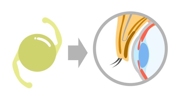 『白内障手術』の多焦点眼内レンズ、向いている人の特徴と診断基準【医師解説】