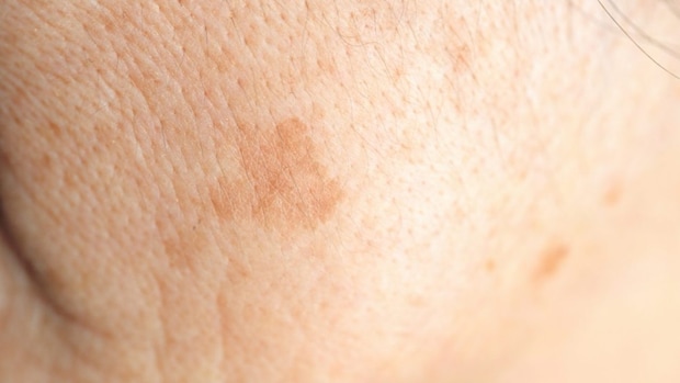 皮膚科医が教える「セルフケアが有効なシミ」とそうじゃないシミの違いの見分け方