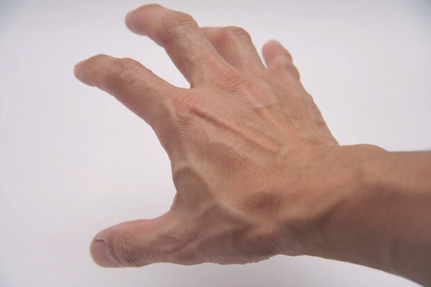 【闘病】「顔の吹き出物で受診」したら手の『皮膚がん』が発覚… 2年後には肺への転移も