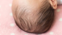 赤ちゃんの『頭のゆがみ』は自然に治る？ 受診目安と「ヘルメット治療」【医師解説】