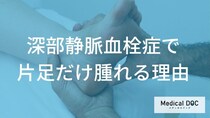 深部静脈血栓症は「左足」に起こりやすい？片足だけが腫れる理由を医師が解説