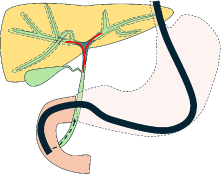 肝門部胆管がんの検査法_内視鏡的逆行性胆管膵管造影(ERCP)