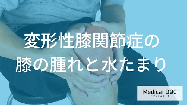 膝の腫れが数日続くときは要注意? 「変形性膝関節症」が疑われるサインと受診の目安を解説
