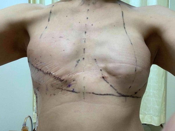予想だにしなかった2度の乳がんと食道がんの体験