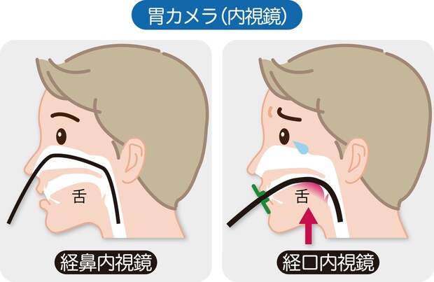 苦痛を軽減したい！ 医師が教える苦痛の少ない内視鏡検査