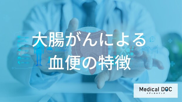 【要注意】いつもの痔と放置しないで!大腸がんが隠れている「血便の色」と2つのサイン