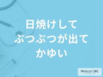 「日焼けしてぶつぶつが出てかゆい」ときの対処法は？日焼け止めについても解説！