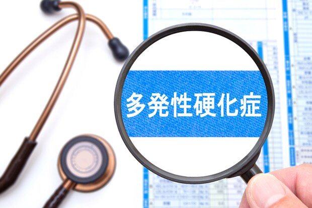 多発性硬化症の診断と治療