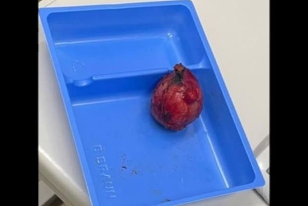 更年期のような症状の原因が実は褐色細胞腫だった