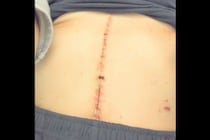 【闘病】ただの「更年期」ではなかった… 呼吸すらできない発作に襲われる『副腎の腫瘍』