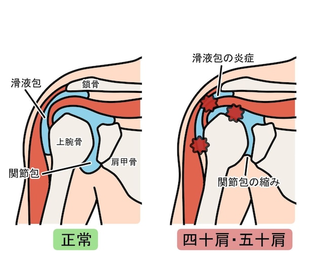 四十肩・五十肩の基本情報