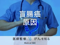 「盲腸癌の原因」はご存知ですか？症状や検査法も解説！【医師監修】